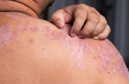 El Hospital San José ofrece turnos gratuitos para atender lesiones asociadas a la psoriasis